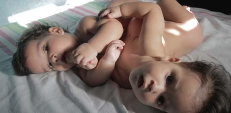 Gêmeos siameses apresentam evolução clínica após cirurgia