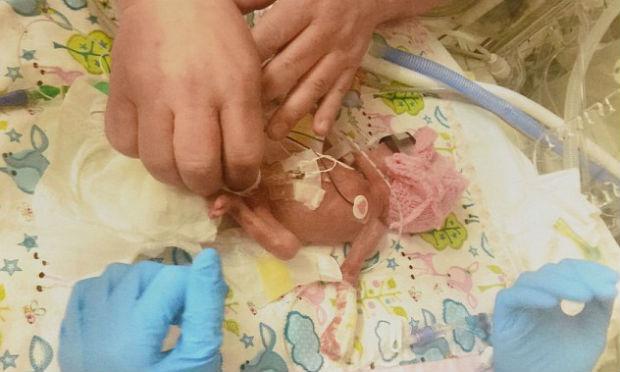 Francesca nasceu com apenas 24 semanas e com poucas chances de sobreviver / Foto: reprodução/Daily Mail