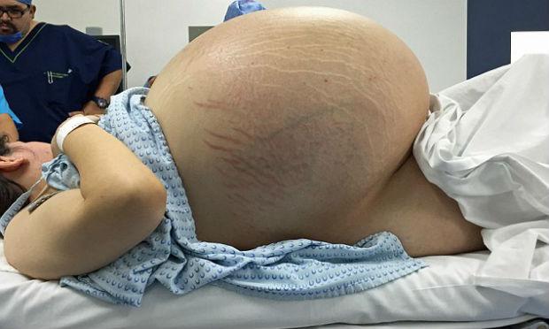 Mulher achou que estava engordando ao perceber a barriga crescer / Foto: reprodução